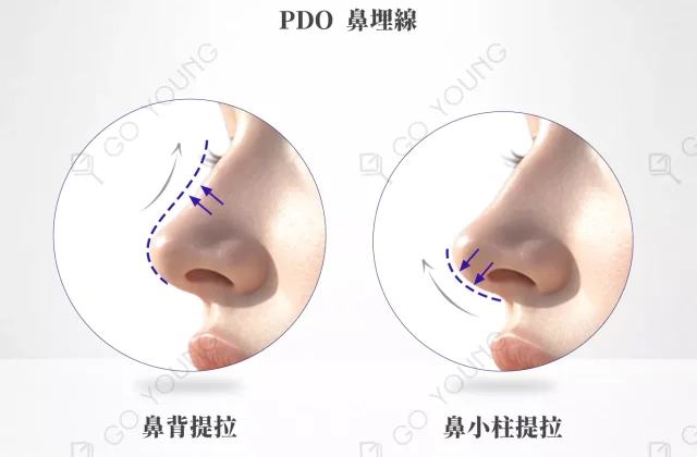 PDO 鼻埋線