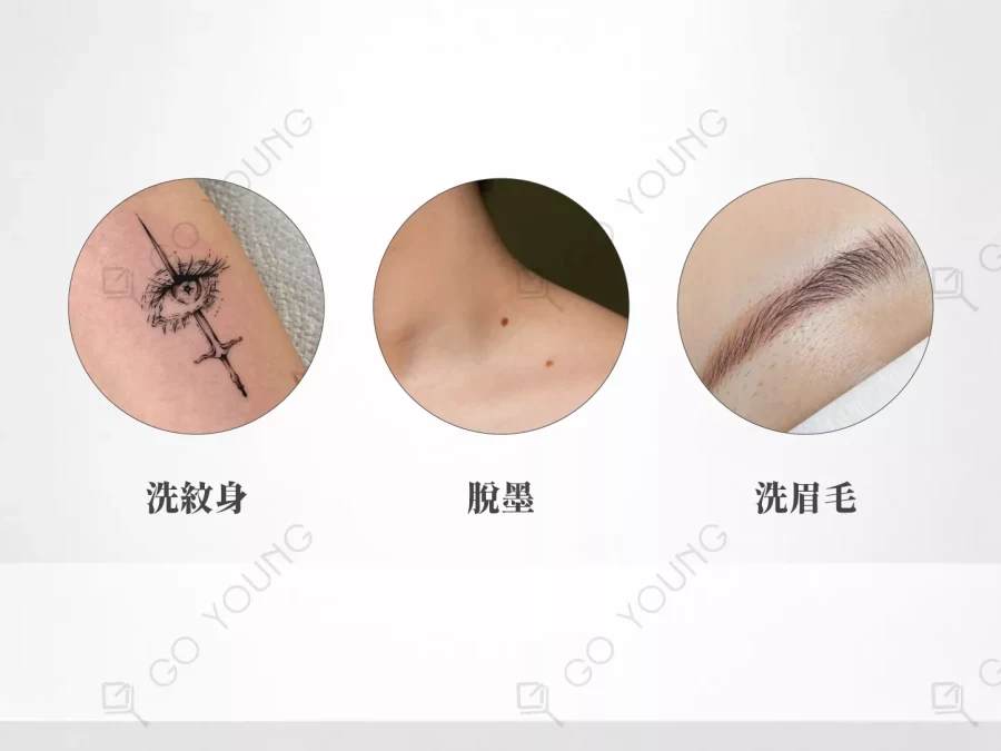 激光洗紋身／激光脫墨／洗眉毛療程療程