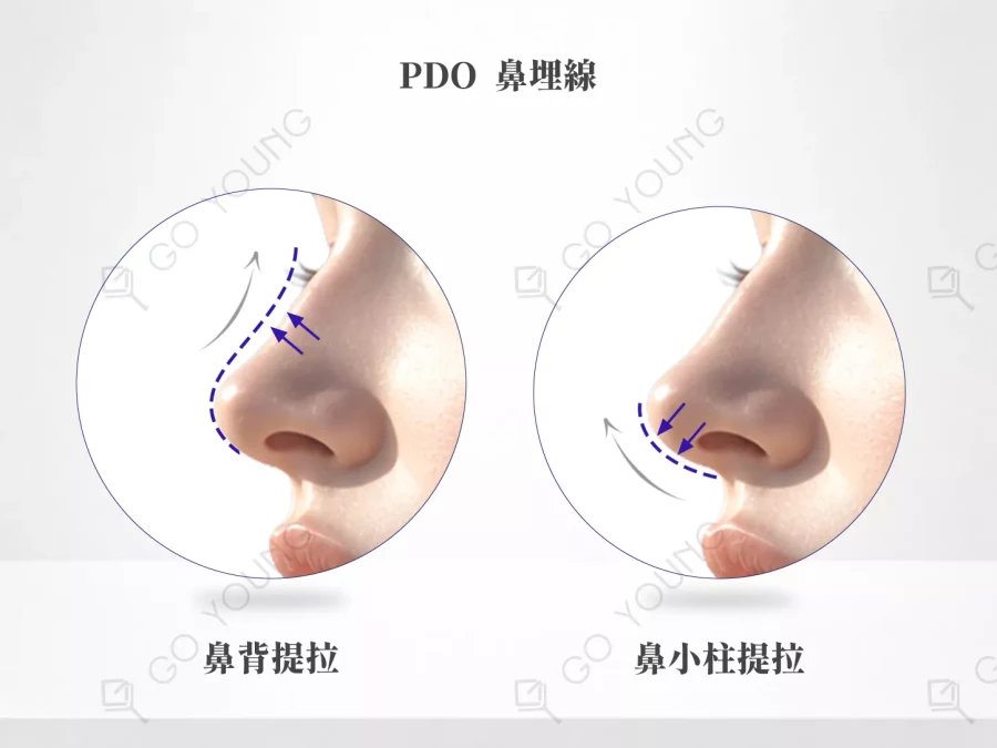 PDO 鼻埋線療程