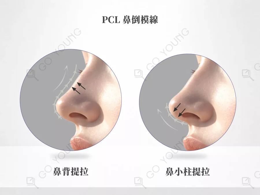 PCL 鼻倒模線療程