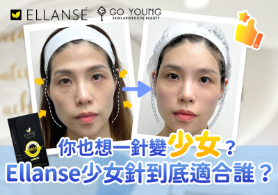 Ellanse少女針：適合哪些人群的美麗選擇 - Go Young