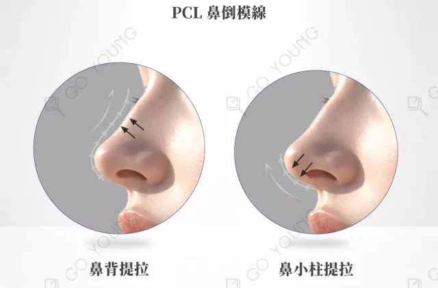 PCL 鼻倒模線
